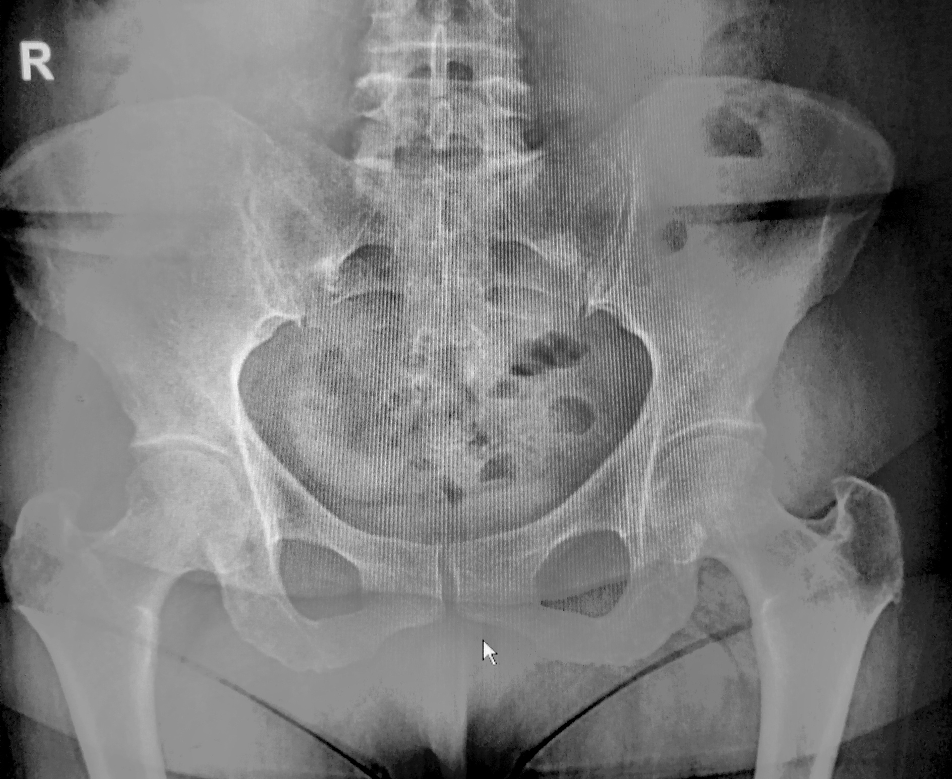 Rx pelvis