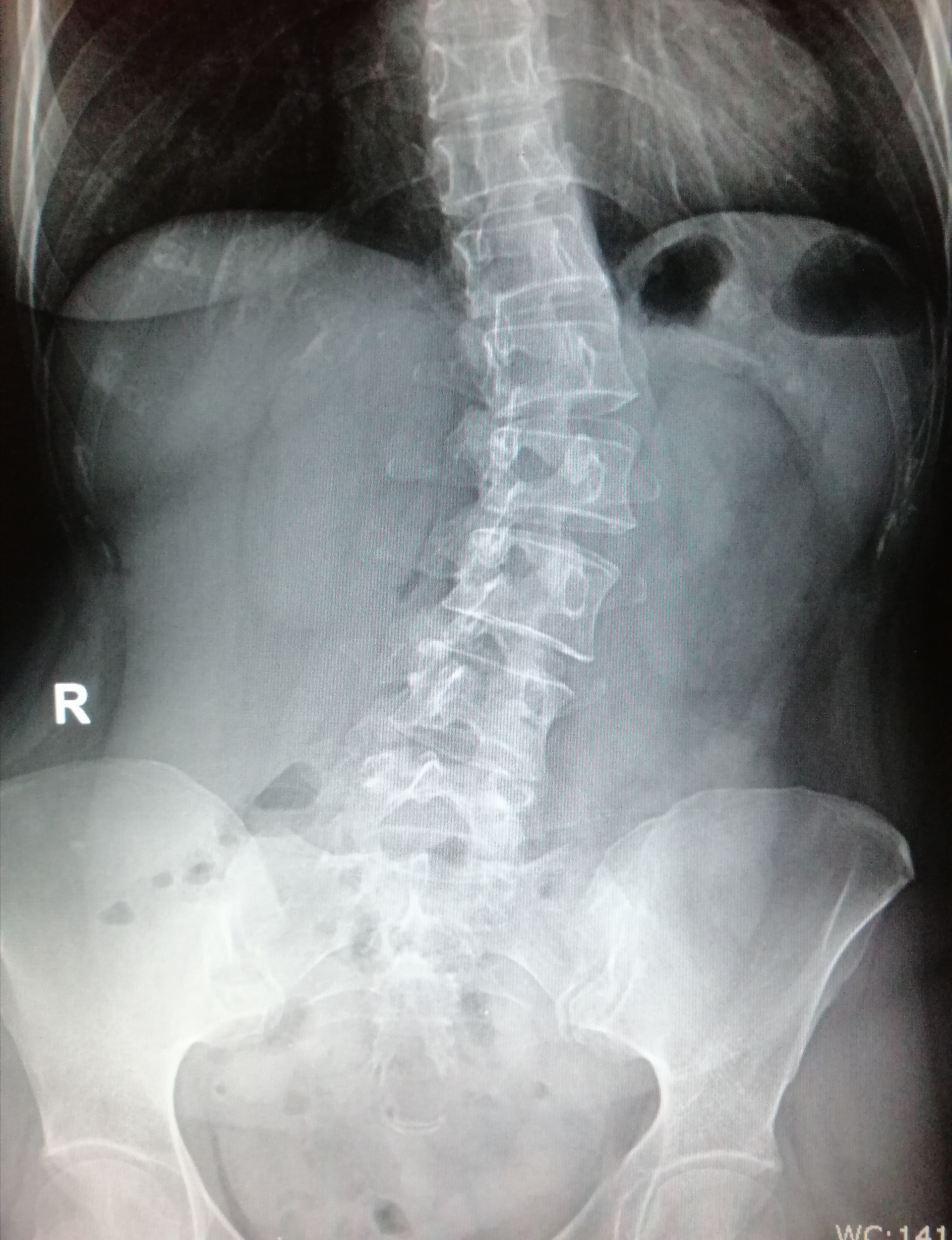 Rx col lumbar