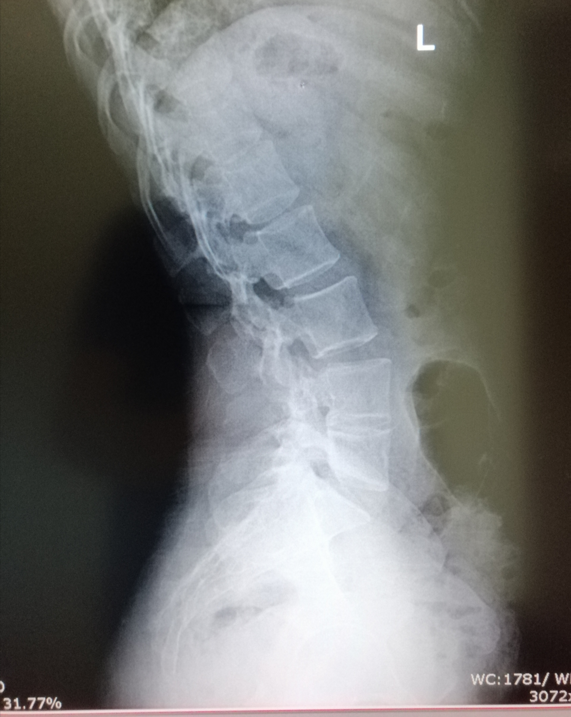 RC COL LUMBAR LATERAL